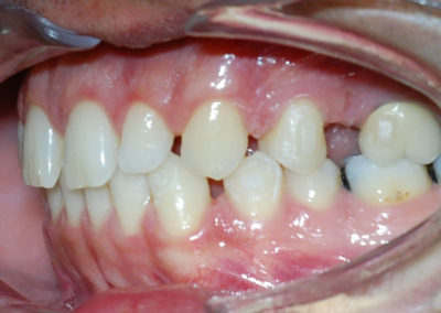 foto-dentatura-prima-dell-ortodonzia-pre-protesica-in-clinica-dal-pont