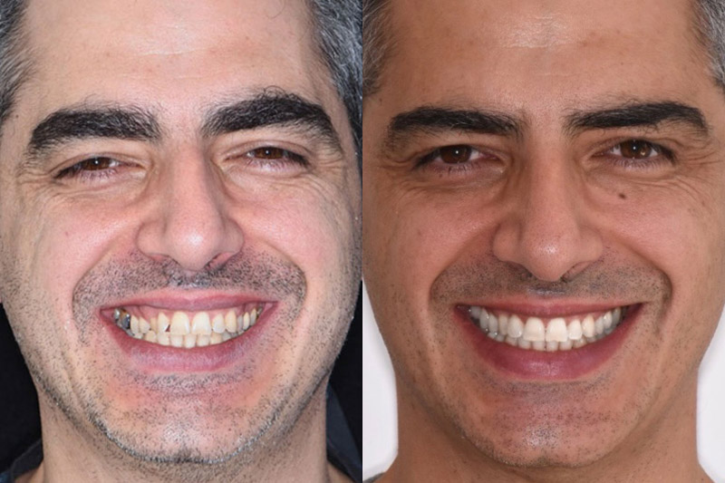 uomo-che-sorride-con-apparecchio-dentale-invisibile-dell-ortodonzia-invisibile-a-belluno