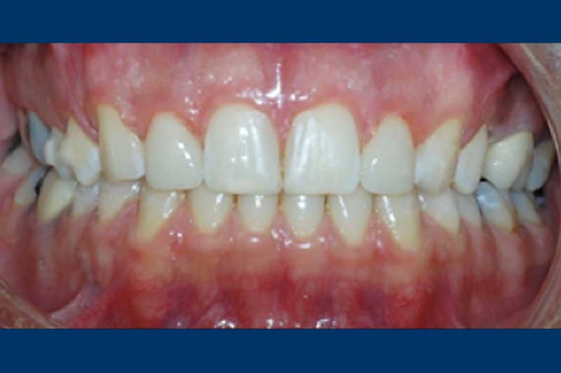 post-ortodonzia-correzione-di-inestetismi-dentali-in-clinica-dal-pont-a-belluno