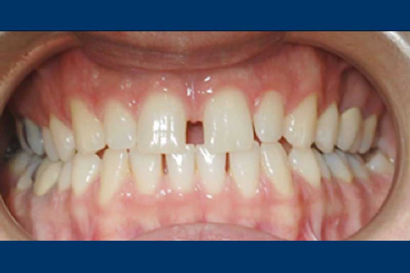 pre-ortodonzia-per-prevenire-o-correggere-malocclusioni-e-inestetismi-dentali-clinica-dal-pont