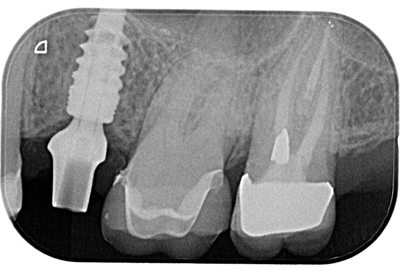 Sostituzione di un dente singolo
