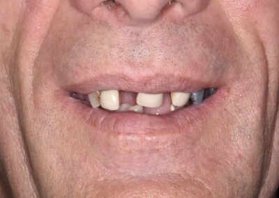 grave patologia dento-parodontale